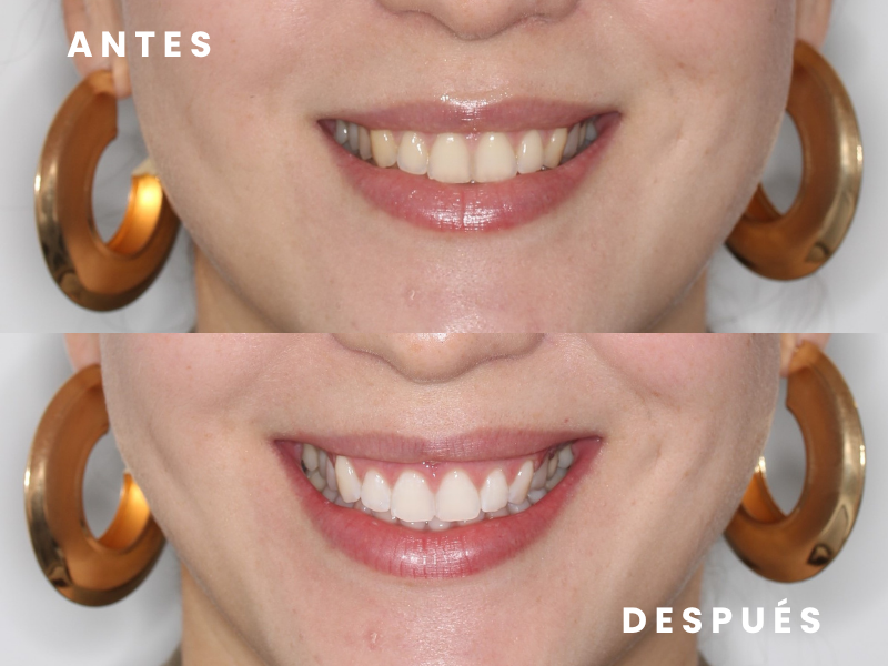 Blanqueamiento dental 5