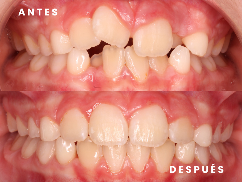 Ortodoncia interceptiva 1