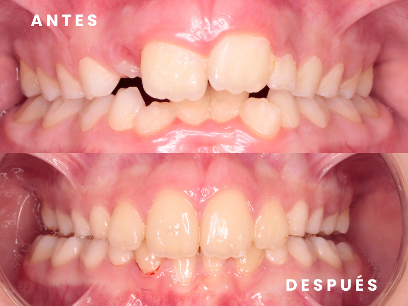 Ortodoncia interceptiva 2