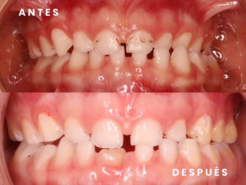 Ortodoncia interceptiva 4