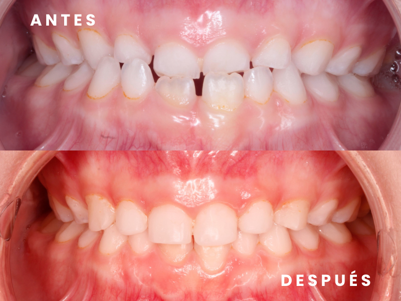 Ortodoncia interceptiva 5